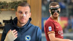 Dzeko gladiatore, dopo la mano si rompe il naso: giocherà con la maschera come a Roma