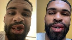 Tutti attorno a Loftus-Cheek: intervento riuscito, le foto prima e dopo