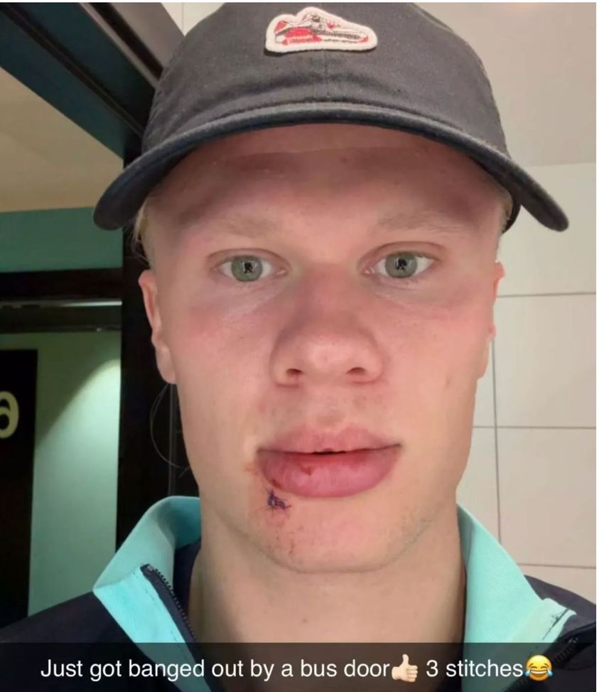 Haaland, tre punti di sutura vicino la bocca: ha sbattuto contro la portiere del pullman- immagine 3