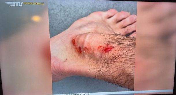 Benfica, impressionante infortunio di Antonio Silva contro il Farense- immagine 2