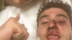 FOTO – Giocatore del Sassuolo a Careggi: botta tremenda e frattura nasale