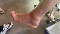 FOTO – Adli e la distorsione alla caviglia: l’impressionante scatto del francese