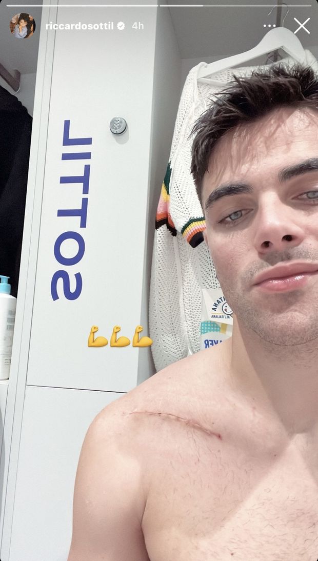 FOTO – Sottil su Instagram mostra la cicatrice dell’operazione - immagine 1